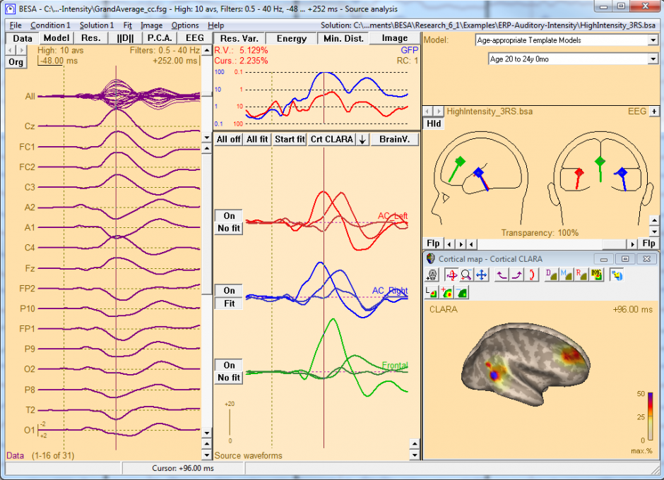 BESA® | Brain Electrical Source Analysis: Features > Source analysis ...